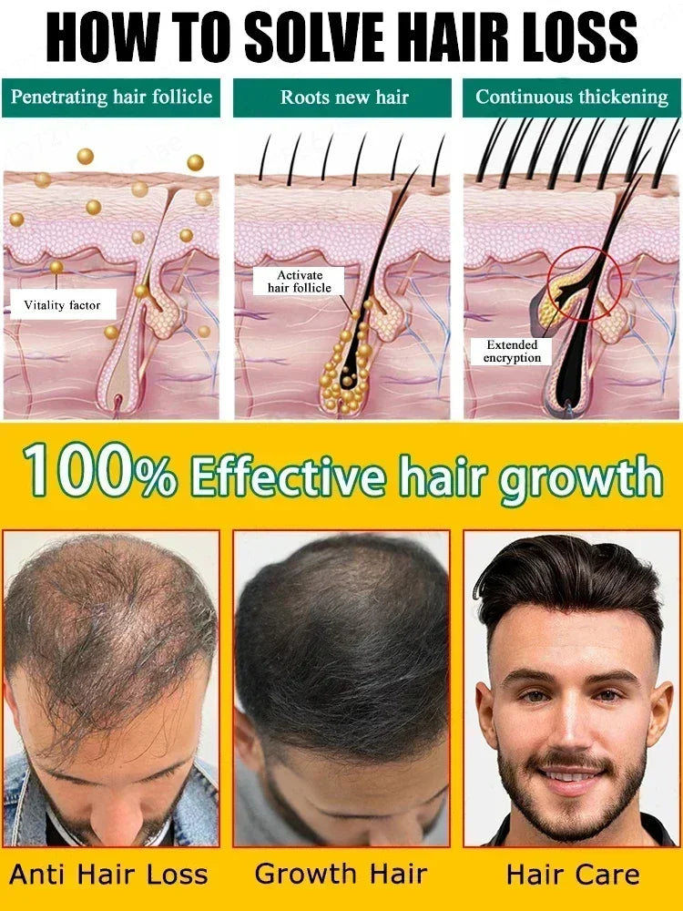 Óleo de crescimento rápido do cabelo, óleo eficaz para reparação da calvície, perda hereditária, pós-parto, cabelo seborreico, anti perda