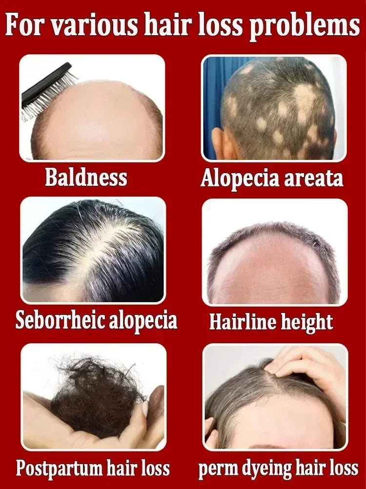 Óleo de crescimento rápido do cabelo, óleo eficaz para reparação da calvície, perda hereditária, pós-parto, cabelo seborreico, anti perda